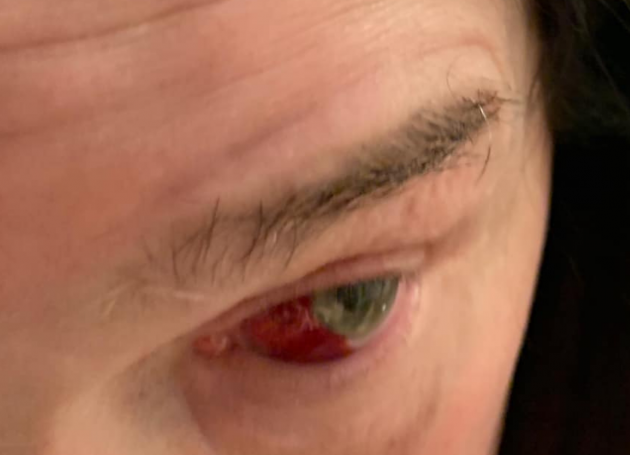 Ozzy Osbourne Breaks His Eye